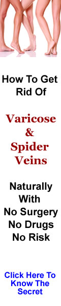Get rid of varicose veins and spider veins naturally without surgery